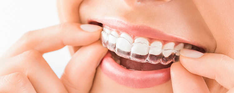 部分矯正でも全体的な矯正治療でも歯の矯正はマウスピース矯正で改善可能