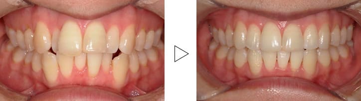 叢生・上下顎前突(出っ歯)
