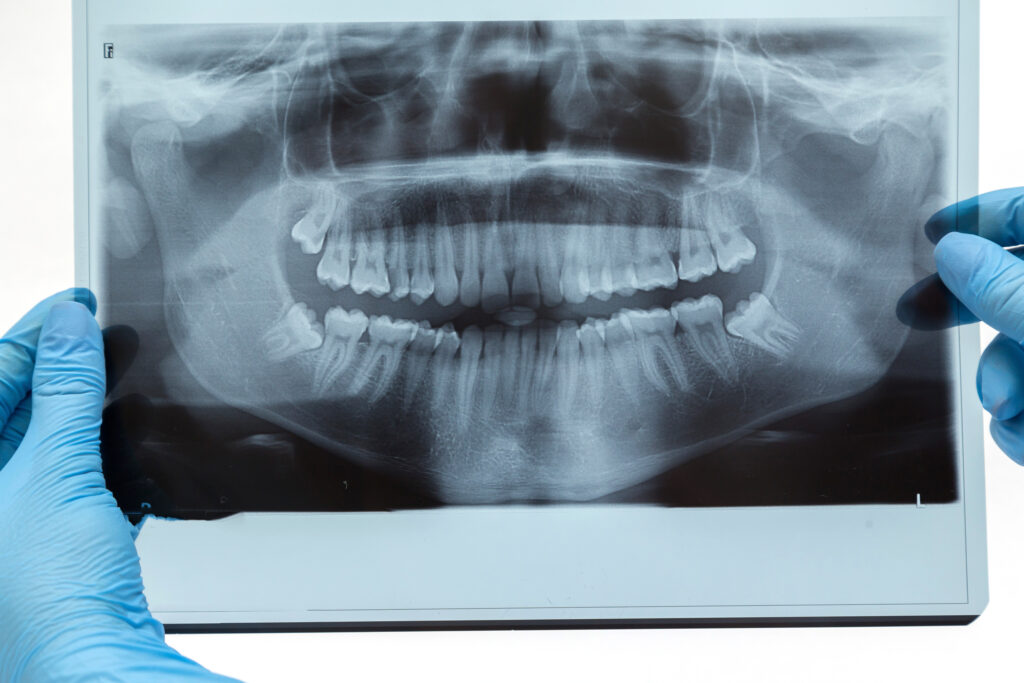 歯科で撮影した歯のレントゲン写真