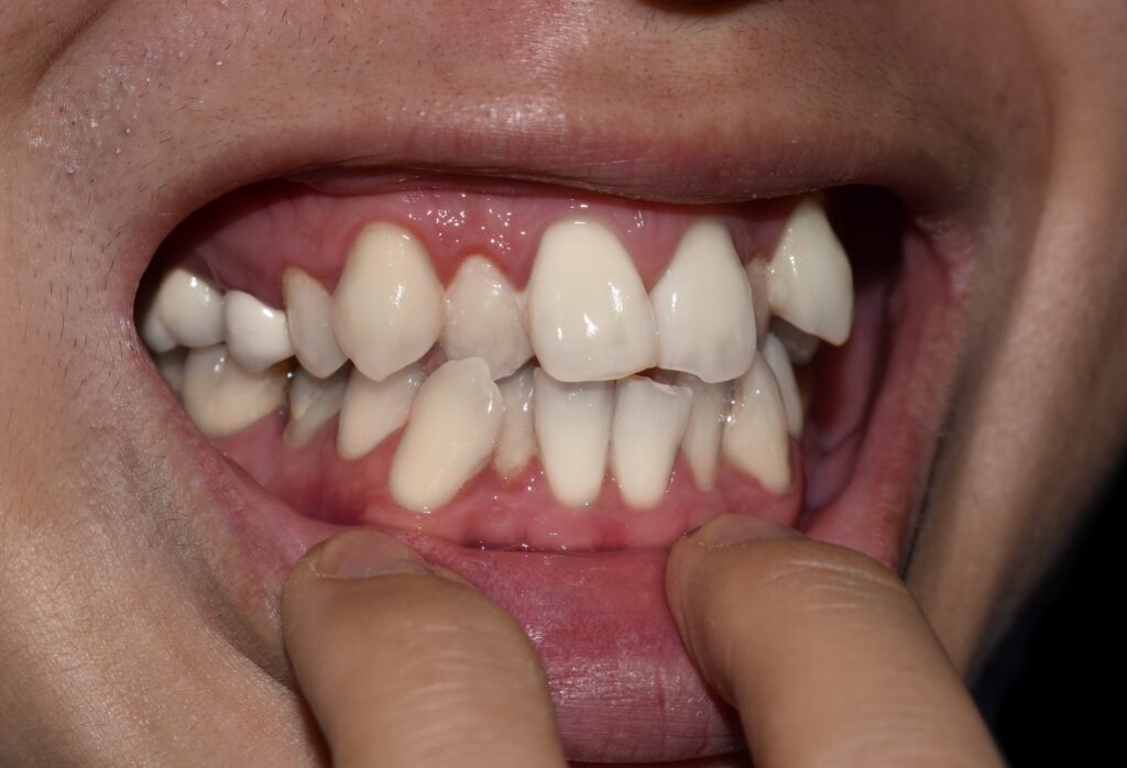 重度の叢生で歯並びがよくない歯列