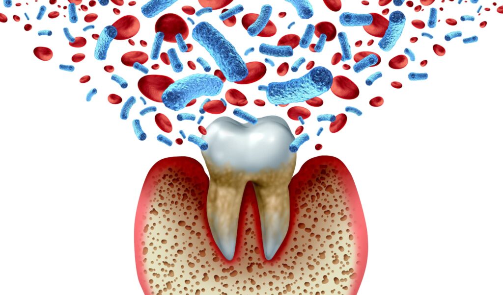 歯周病が全身疾患を招く理由として歯周病菌から出る毒素のイメージ
