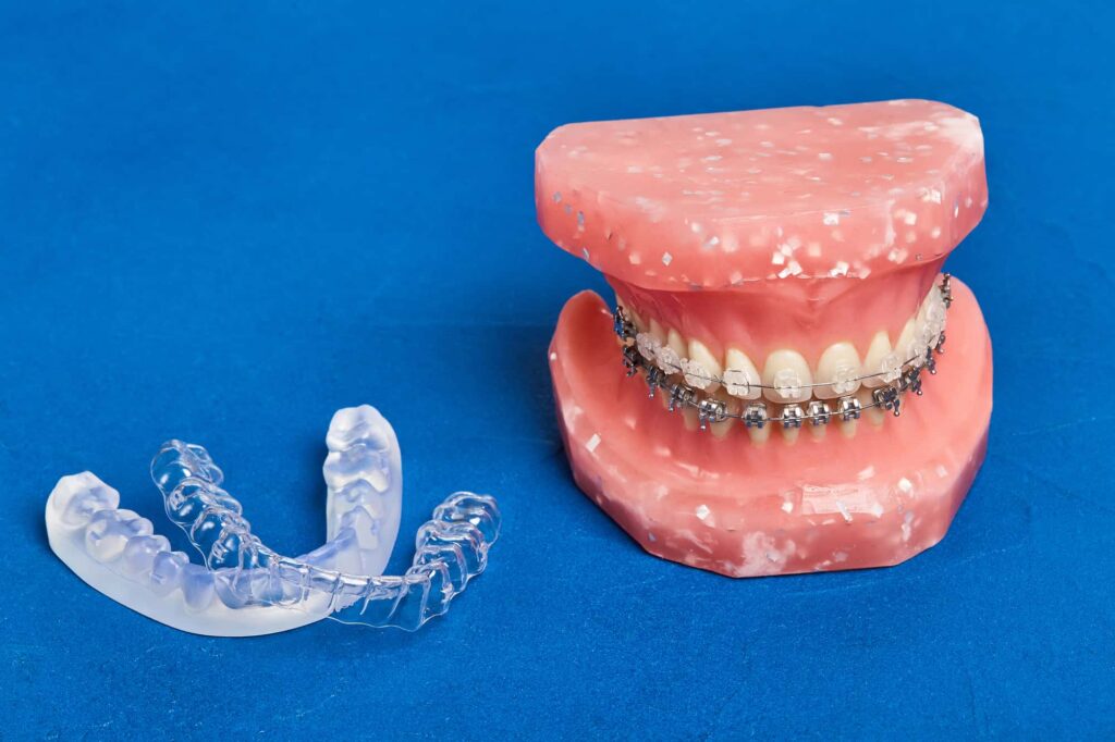 歯並びを矯正する方法であるワイヤー矯正とマウスピース矯正のイメージ