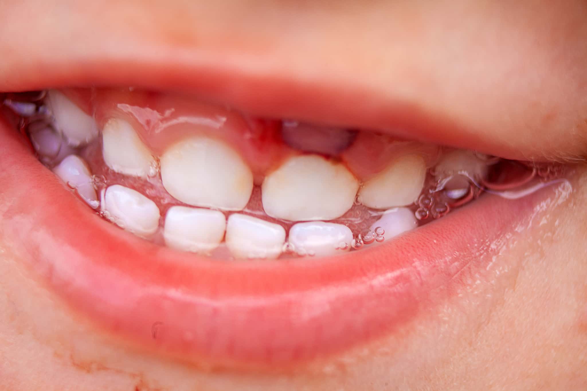 子どもの歯肉炎のイメージ