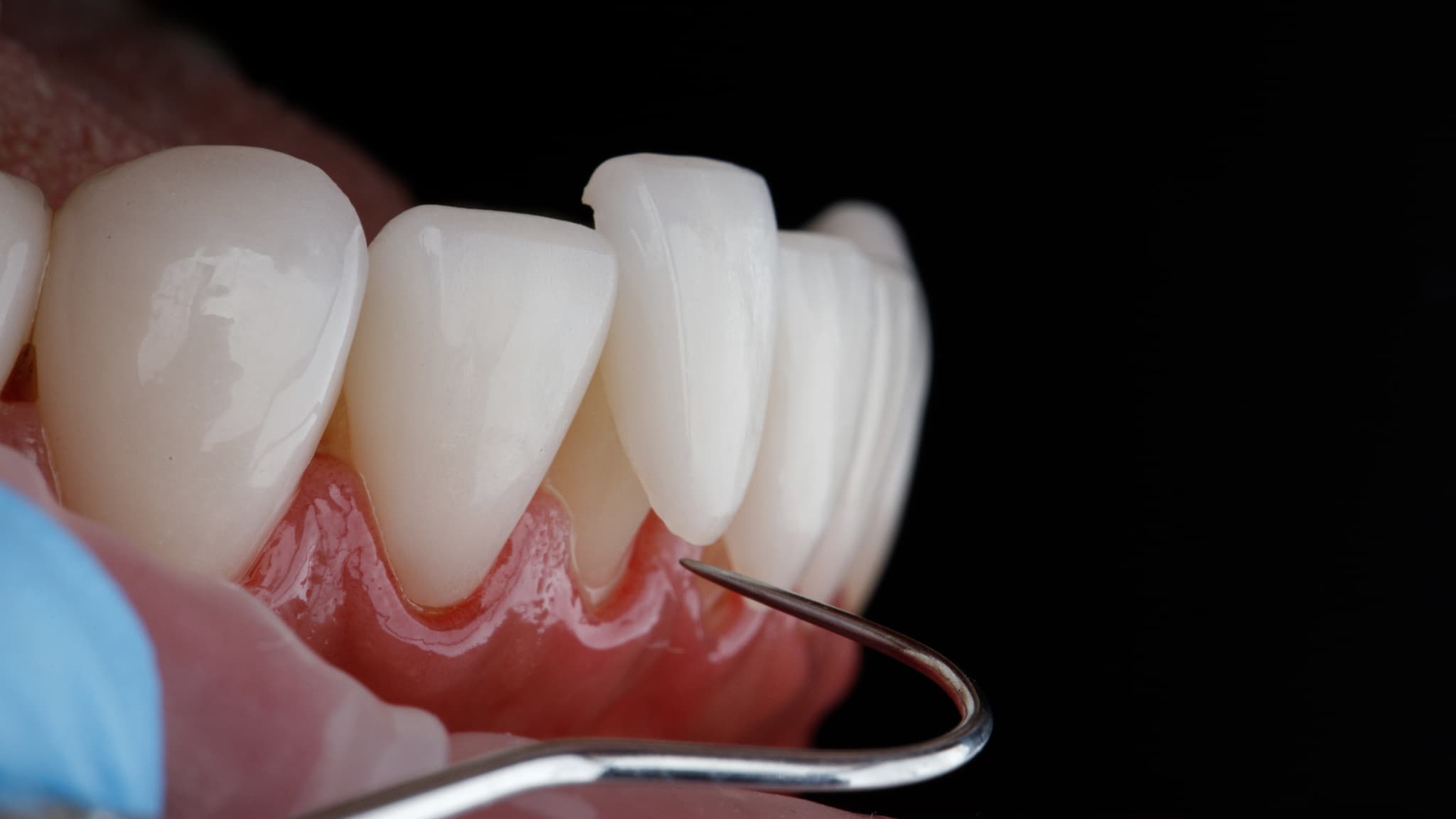 ラミネートベニアの治療の様子