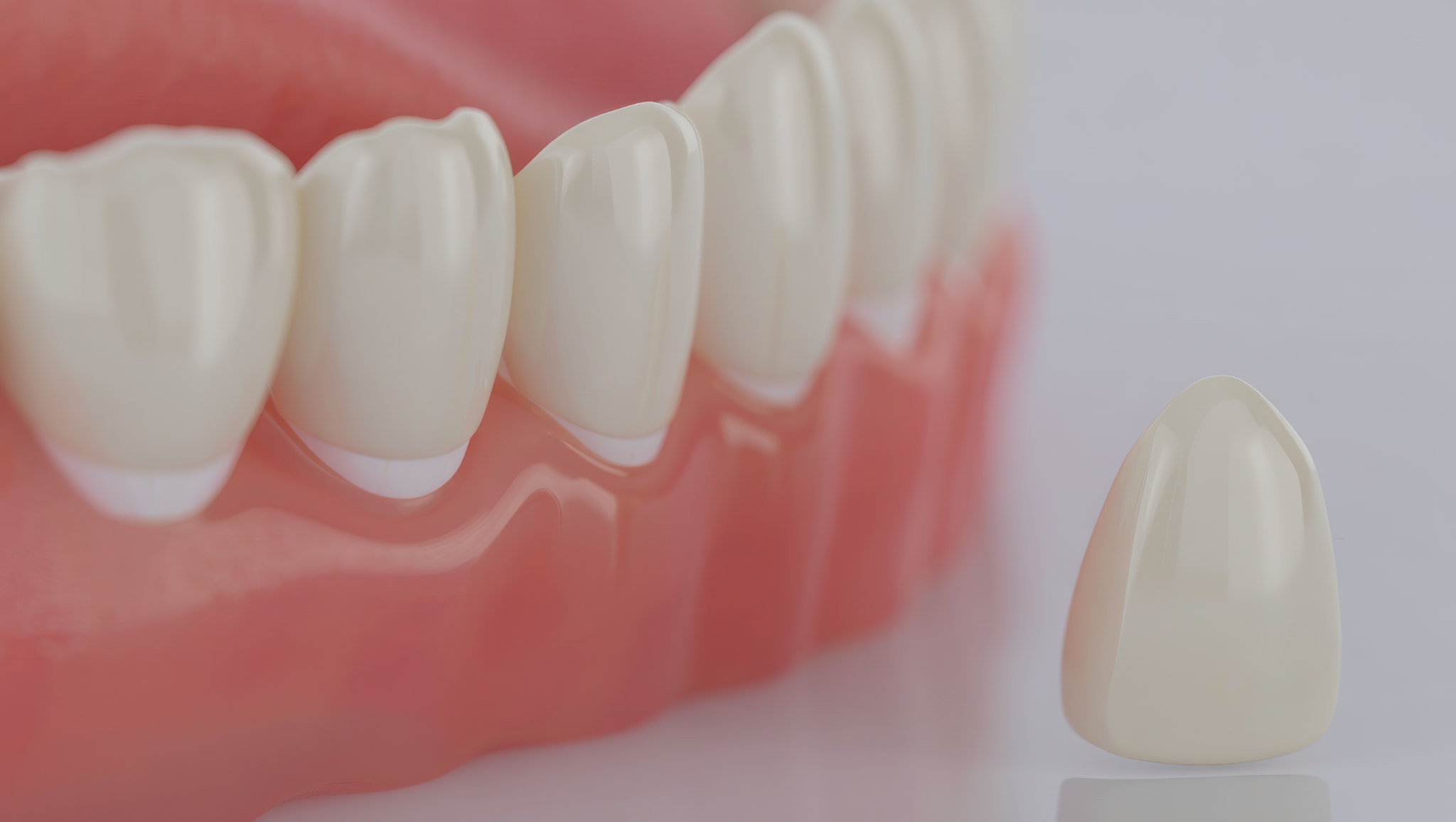 下の歯にラミネートベニアをするイメージ