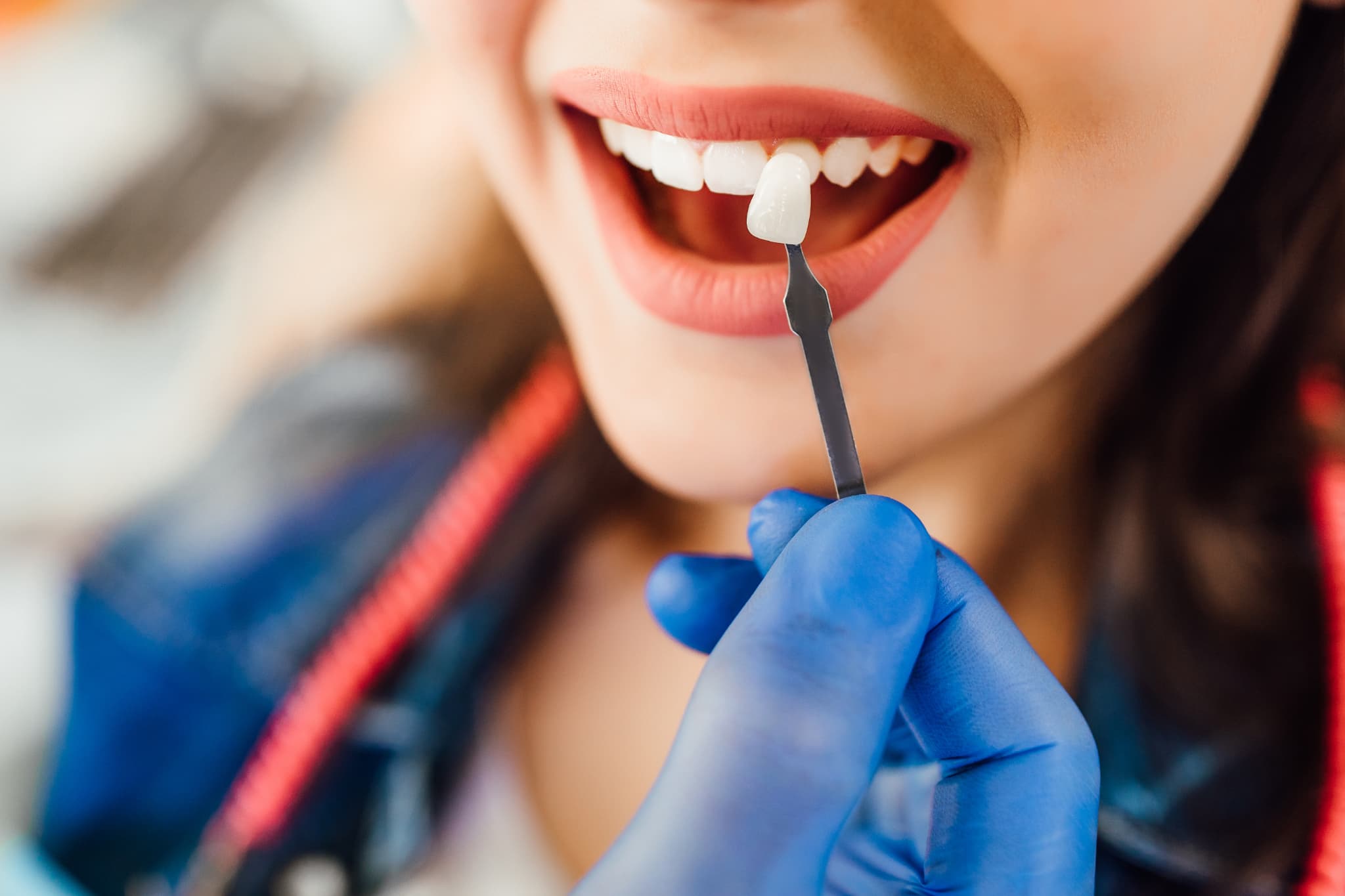 ラミネートべニアの治療の様子