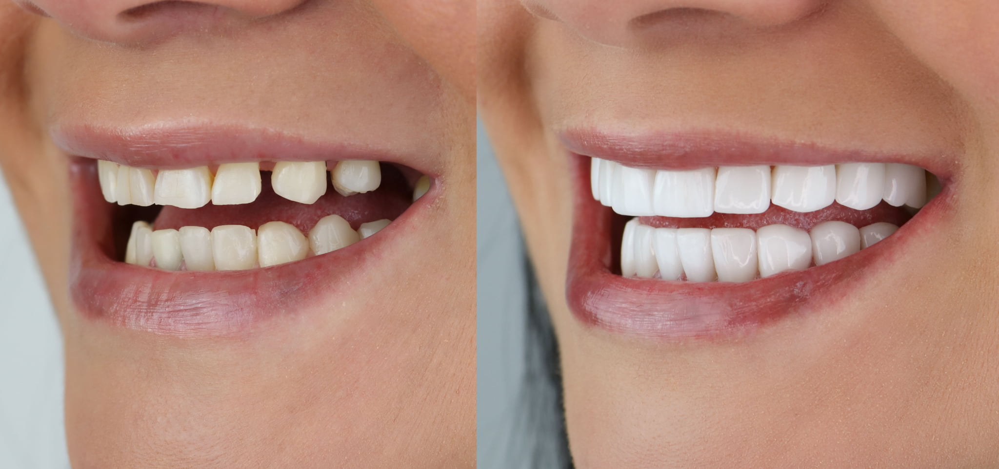 ラミネートベニアをした前後のイメージ