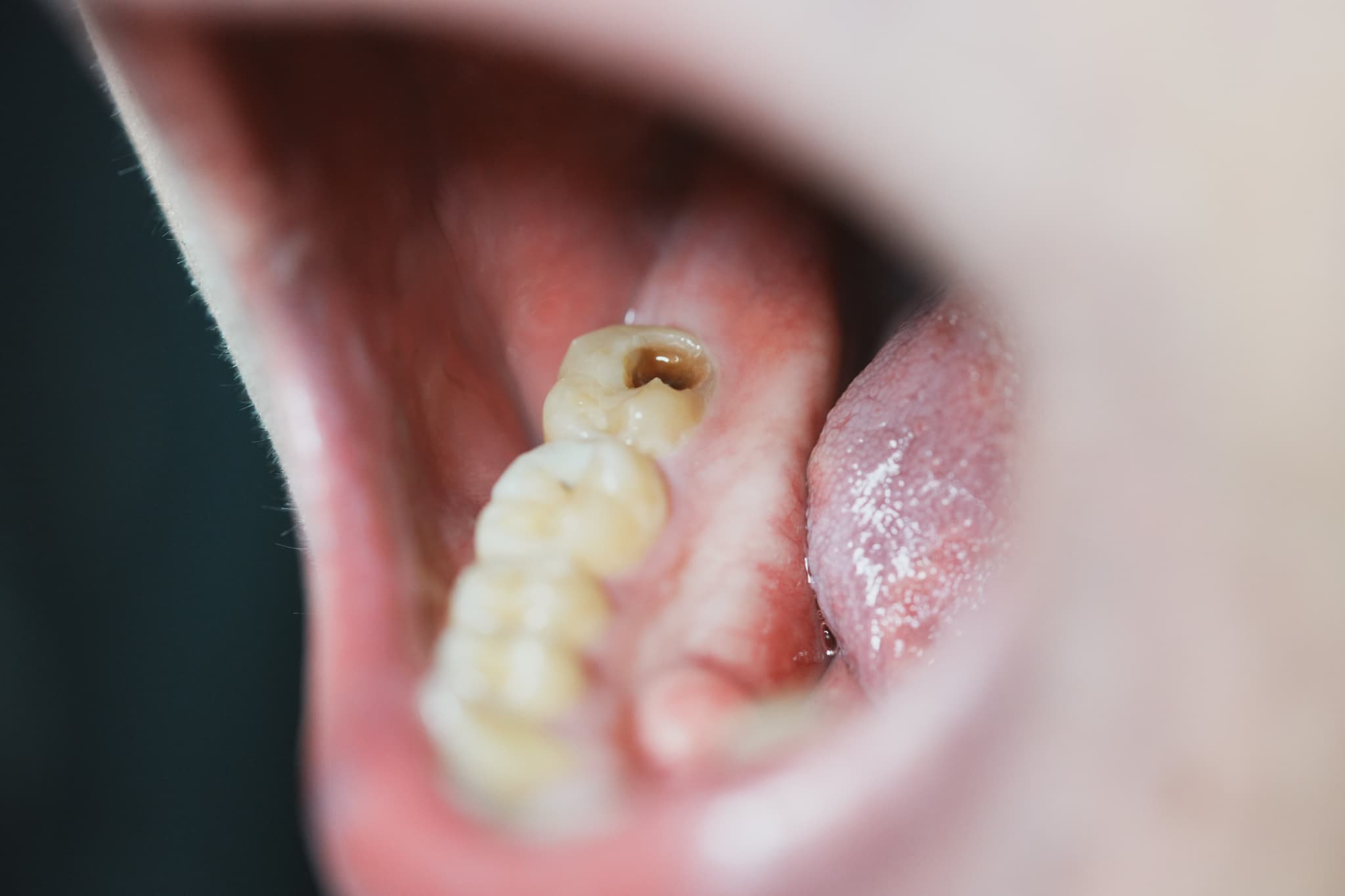 奥歯にできた虫歯